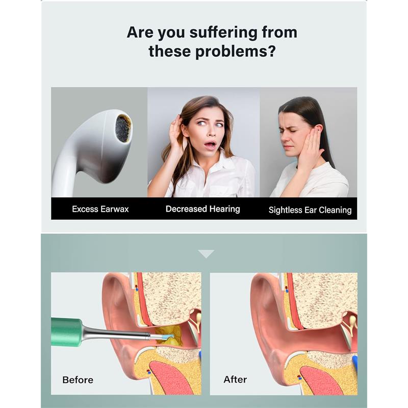 BEBIRD T5 3MP KAMERA 3.5MM LENS ŞARJLI WIFI GÖRÜNTÜLÜ KULAK TEMİZLEYİCİ YEŞİL RENK -4254753